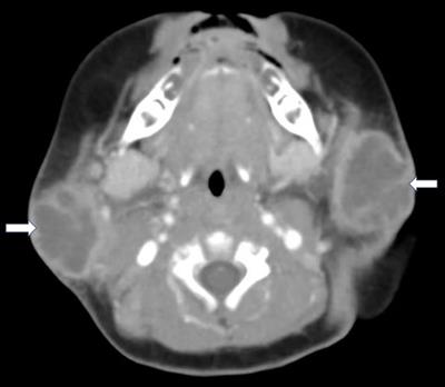 Case report: Bilateral parotid abscess in a 54-day-old infant